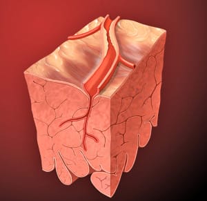 Coronary Artery Lesion