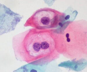 HPV and Cancer