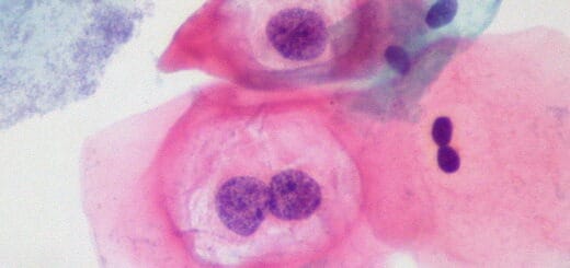 HPV and Cancer