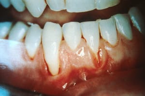 Oral Cancer