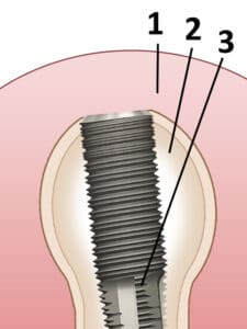 Peizosurgery