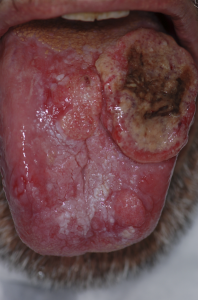 Oral Cancer Patients