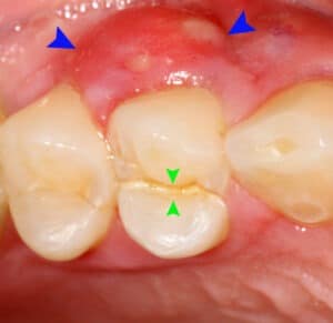 periodontal abscess