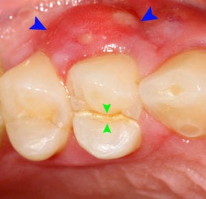 Cracked Tooth