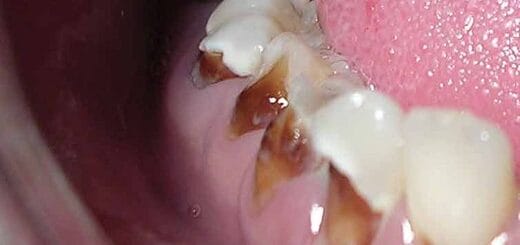 Dental Damages